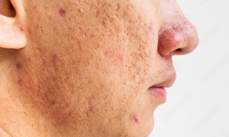 Acne & Acne Scars