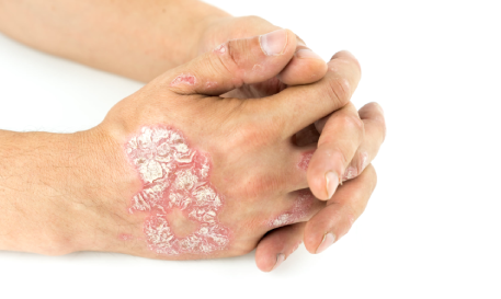 Dark Circles & Stretch Marks